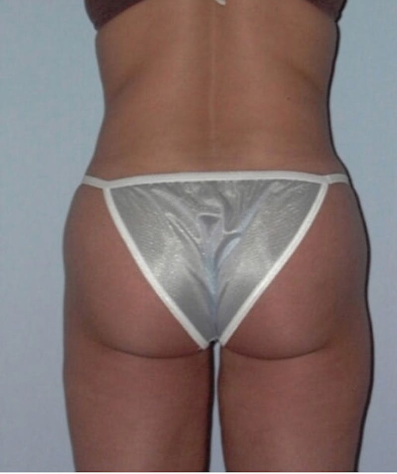Liposuction Before & After Gallery - Patient 133023732 - Image 5