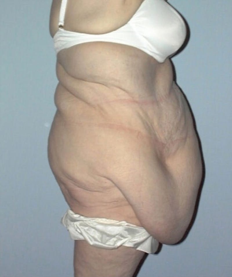 Post Weight Loss Surgery Before & After Gallery - Patient 133023733 - Image 3