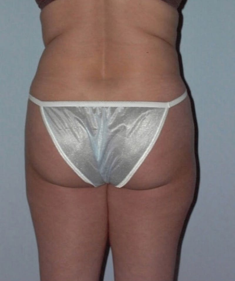 Liposuction Before & After Gallery - Patient 133023732 - Image 6