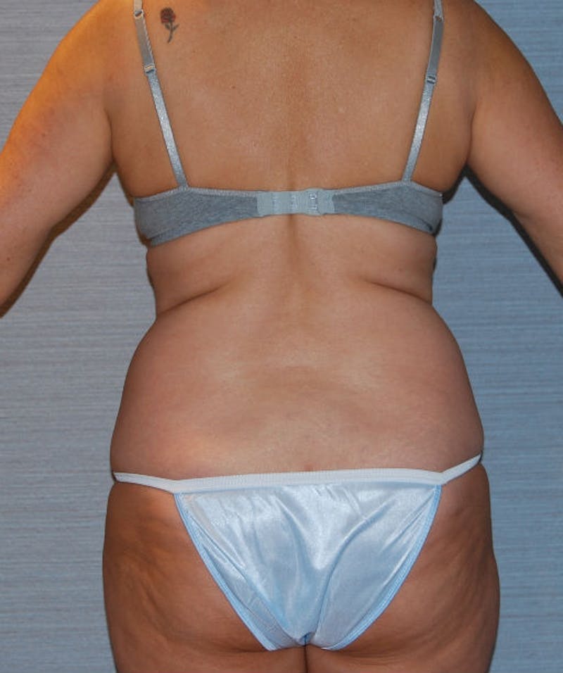 Tummy Tuck Before & After Gallery - Patient 133023734 - Image 5