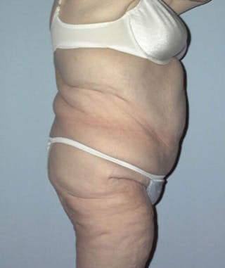 Post Weight Loss Surgery Before & After Gallery - Patient 133023733 - Image 4