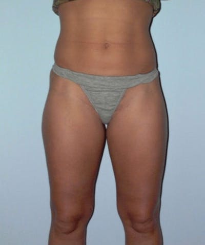 Liposuction Before & After Gallery - Patient 133023737 - Image 1