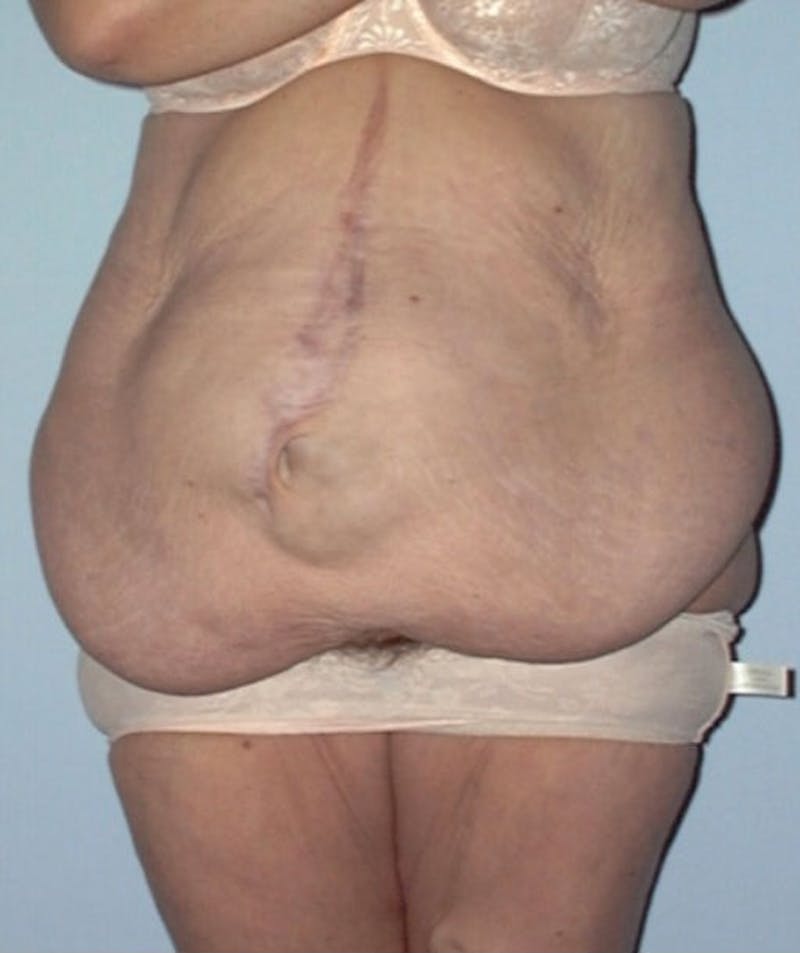 Post Weight Loss Surgery Before & After Gallery - Patient 133023738 - Image 1