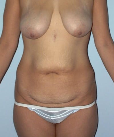 Tummy Tuck Before & After Gallery - Patient 133023741 - Image 1