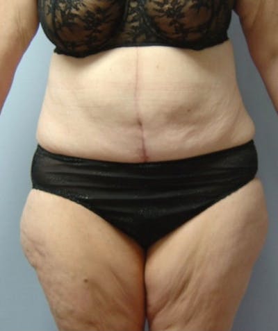Post Weight Loss Surgery Before & After Gallery - Patient 133023738 - Image 2