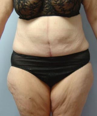 Post Weight Loss Surgery Before & After Gallery - Patient 133023738 - Image 2