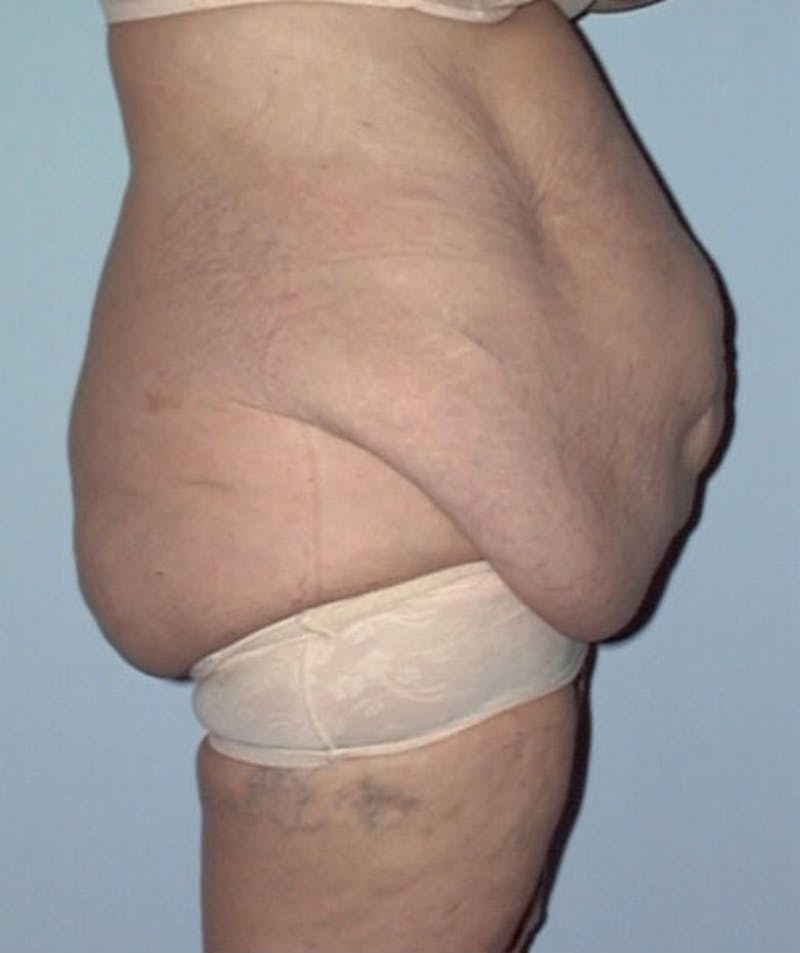 Post Weight Loss Surgery Before & After Gallery - Patient 133023738 - Image 3