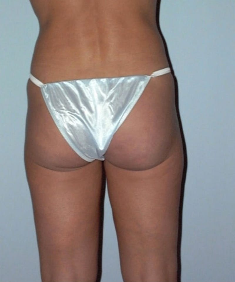 Liposuction Before & After Gallery - Patient 133023737 - Image 4