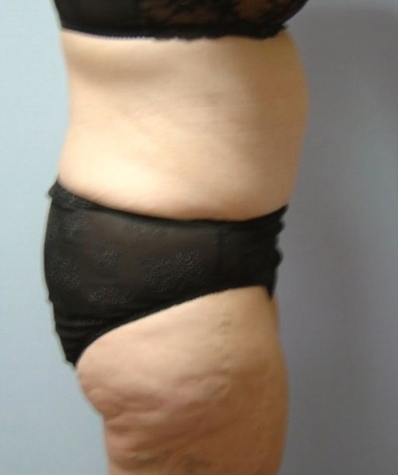 Post Weight Loss Surgery Before & After Gallery - Patient 133023738 - Image 4