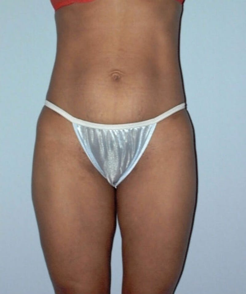 Liposuction Before & After Gallery - Patient 133023742 - Image 2