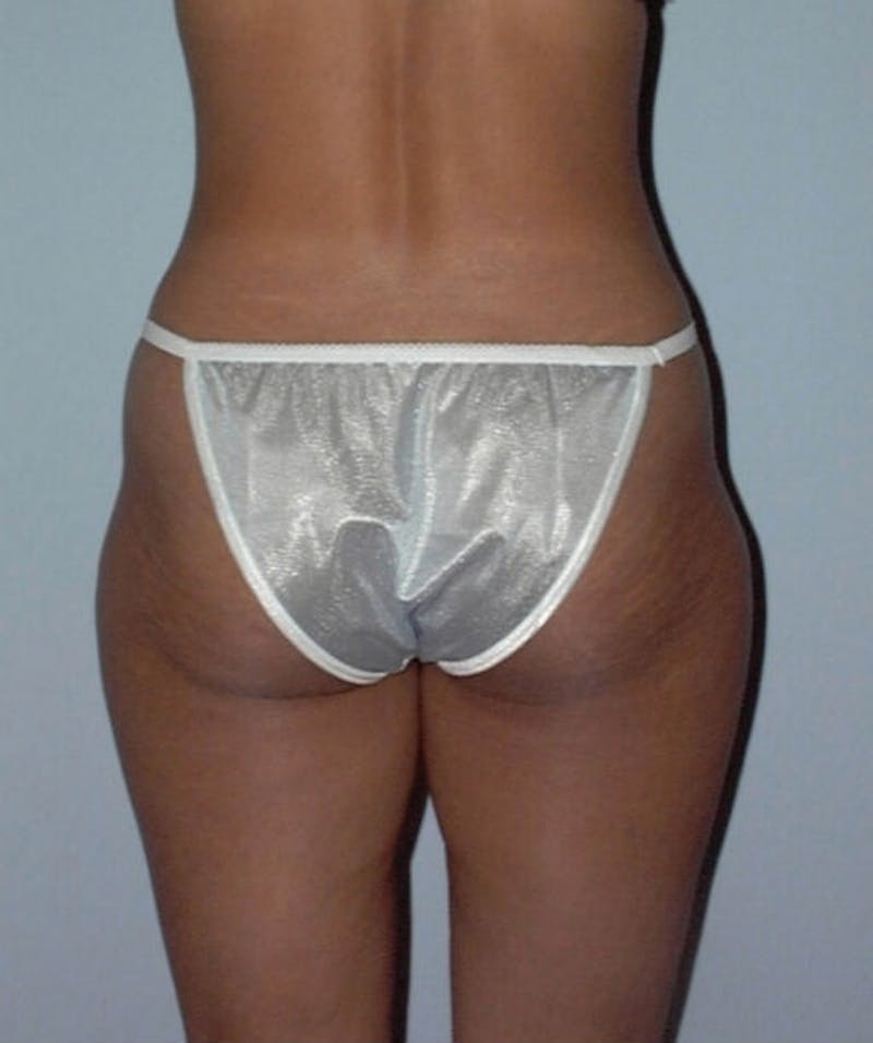 Liposuction Before & After Gallery - Patient 133023742 - Image 3