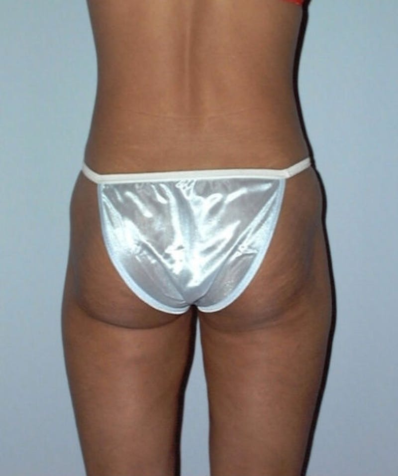 Liposuction Before & After Gallery - Patient 133023742 - Image 4