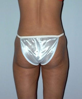 Liposuction Before & After Gallery - Patient 133023742 - Image 4