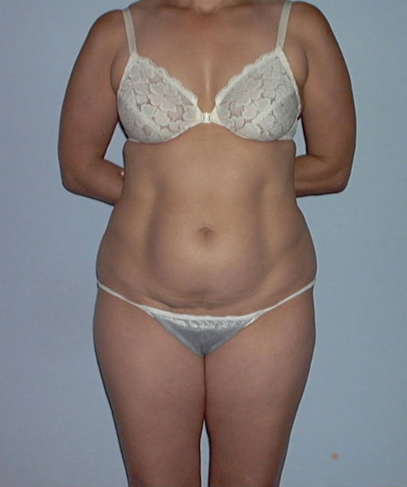 Tummy Tuck Before & After Gallery - Patient 133023746 - Image 1