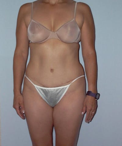 Tummy Tuck Before & After Gallery - Patient 133023746 - Image 2