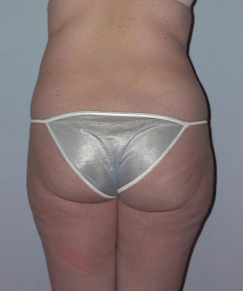 Liposuction Before & After Gallery - Patient 133023749 - Image 1