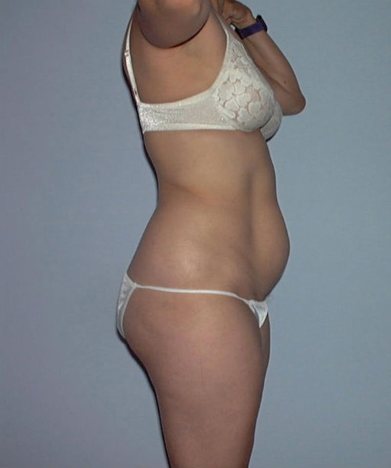 Tummy Tuck Before & After Gallery - Patient 133023746 - Image 3