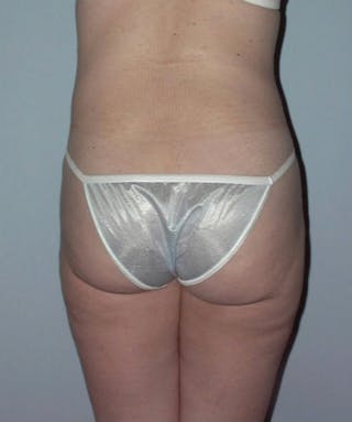 Liposuction Before & After Gallery - Patient 133023749 - Image 2