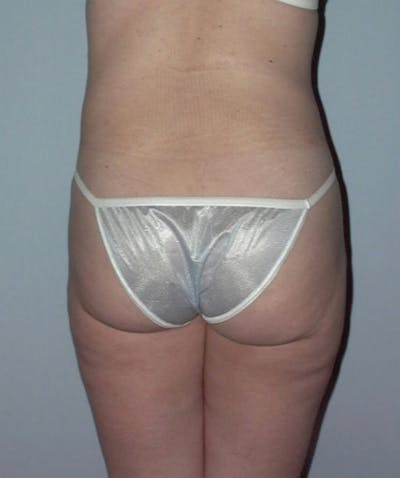Liposuction Before & After Gallery - Patient 133023749 - Image 2