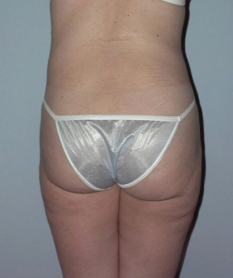 Liposuction Before & After Gallery - Patient 133023749 - Image 2