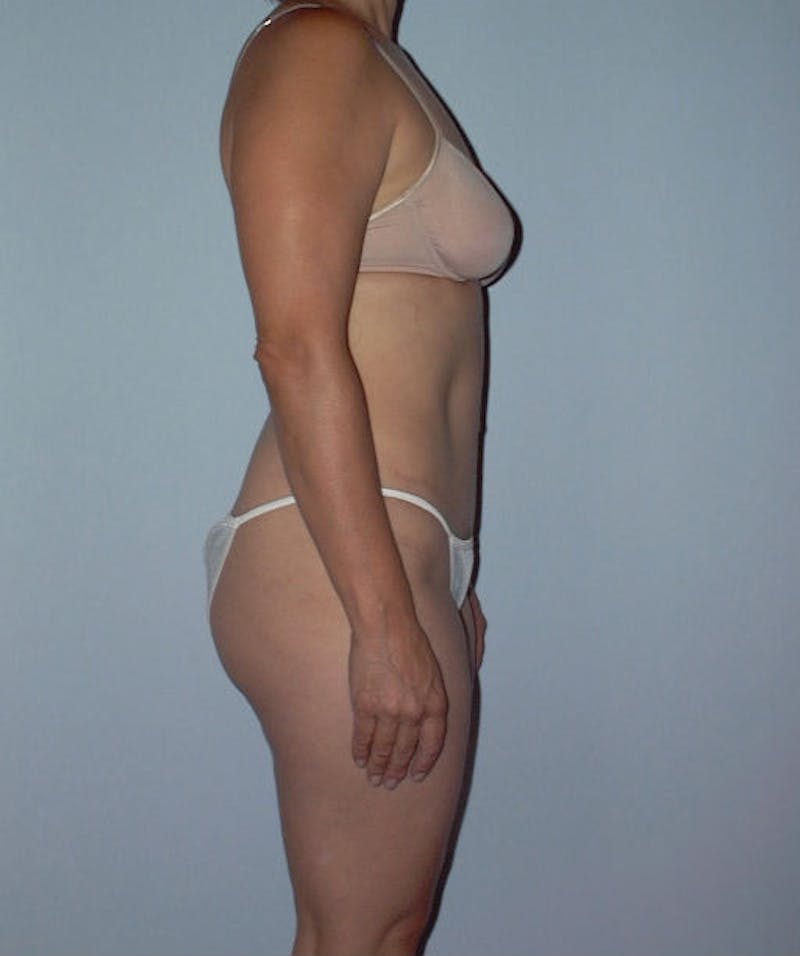 Tummy Tuck Before & After Gallery - Patient 133023746 - Image 4