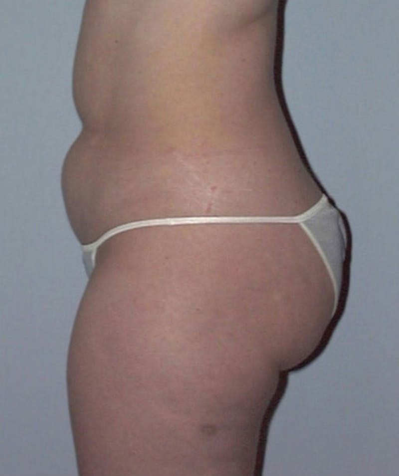 Liposuction Before & After Gallery - Patient 133023749 - Image 3
