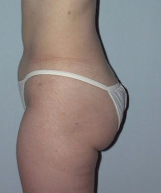 Liposuction Before & After Gallery - Patient 133023749 - Image 4