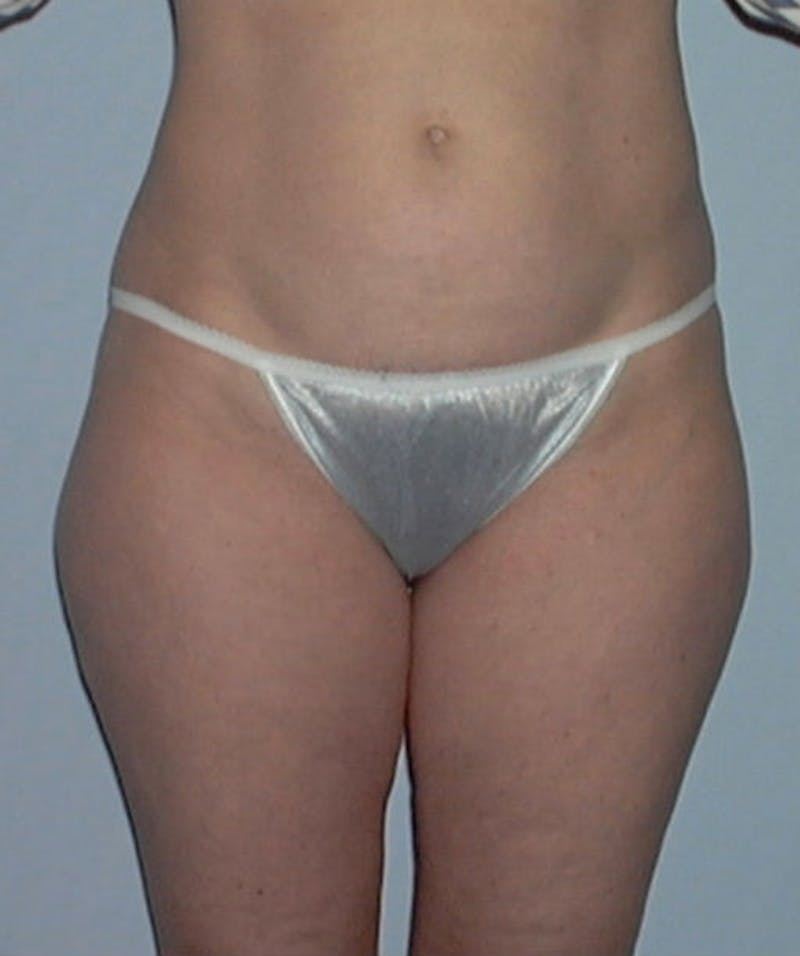 Liposuction Before & After Gallery - Patient 133023759 - Image 1