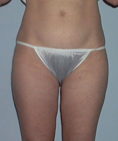 Liposuction Before & After Gallery - Patient 133023759 - Image 2