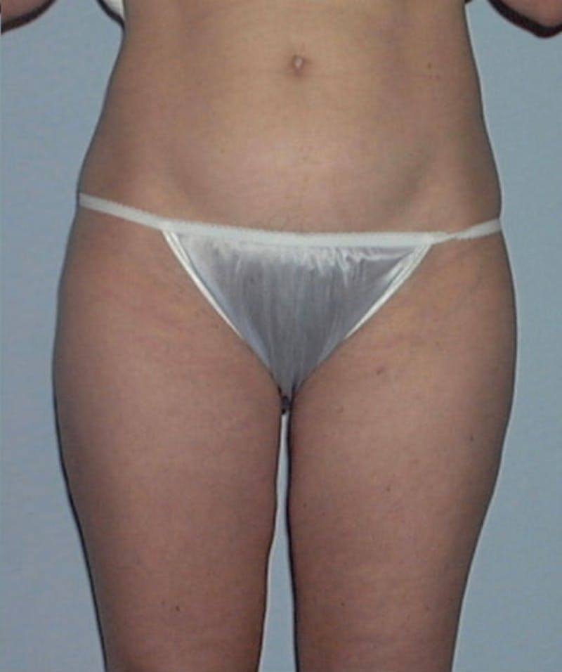 Liposuction Before & After Gallery - Patient 133023759 - Image 2