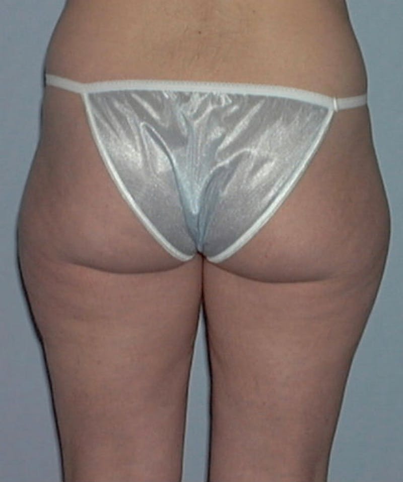 Liposuction Before & After Gallery - Patient 133023759 - Image 3