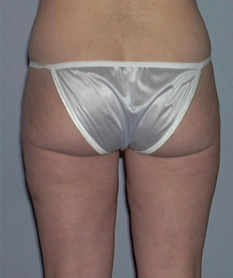 Liposuction Before & After Gallery - Patient 133023759 - Image 4