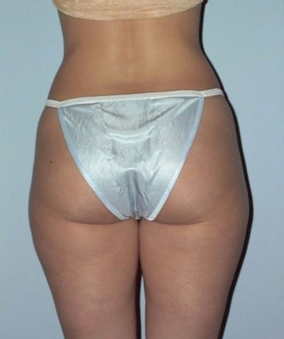 Liposuction Before & After Gallery - Patient 133023765 - Image 1