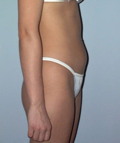 Liposuction Before & After Gallery - Patient 133023768 - Image 1