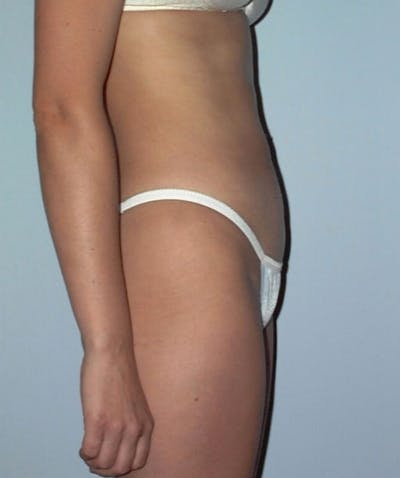 Liposuction Before & After Gallery - Patient 133023768 - Image 2