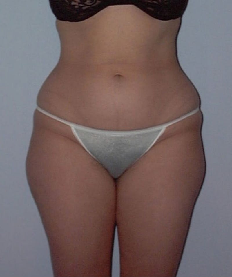 Liposuction Before & After Gallery - Patient 133023776 - Image 1