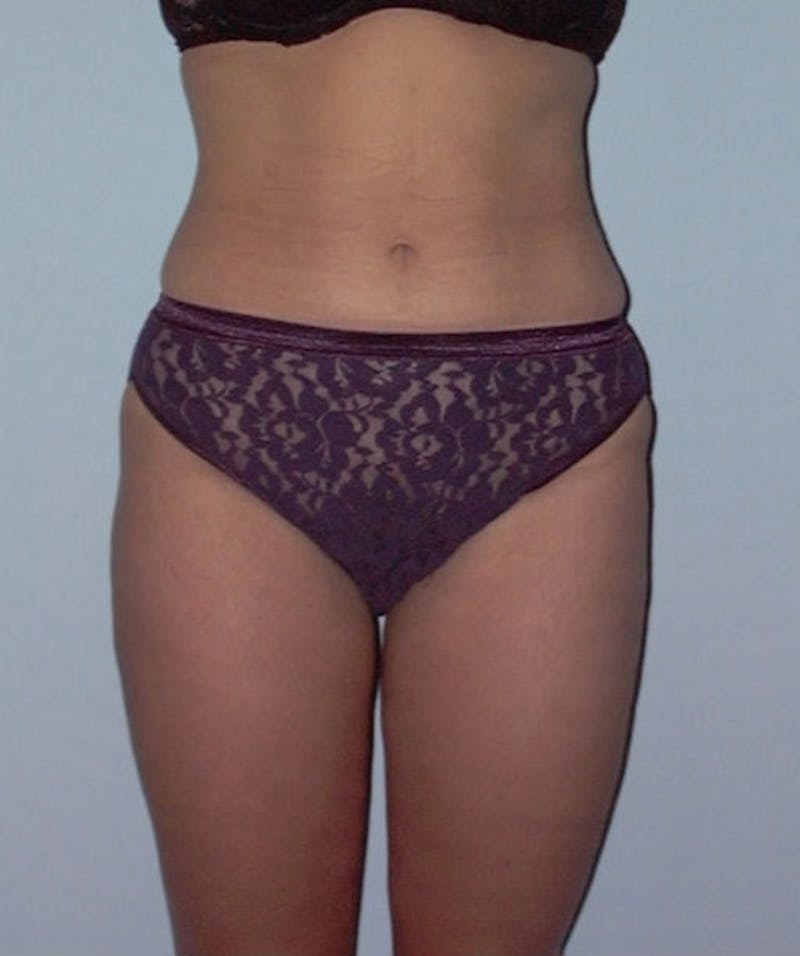 Liposuction Before & After Gallery - Patient 133023776 - Image 2