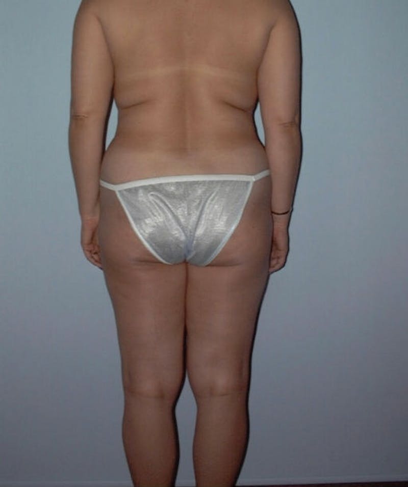 Liposuction Before & After Gallery - Patient 133023781 - Image 1