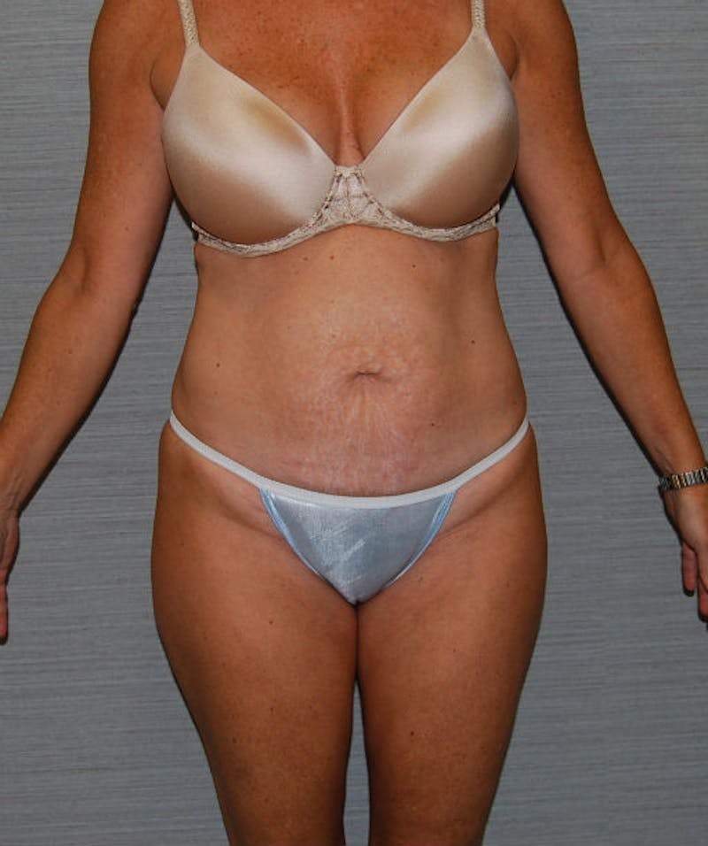 Tummy Tuck Before & After Gallery - Patient 133023784 - Image 1