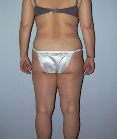 Liposuction Before & After Gallery - Patient 133023781 - Image 2