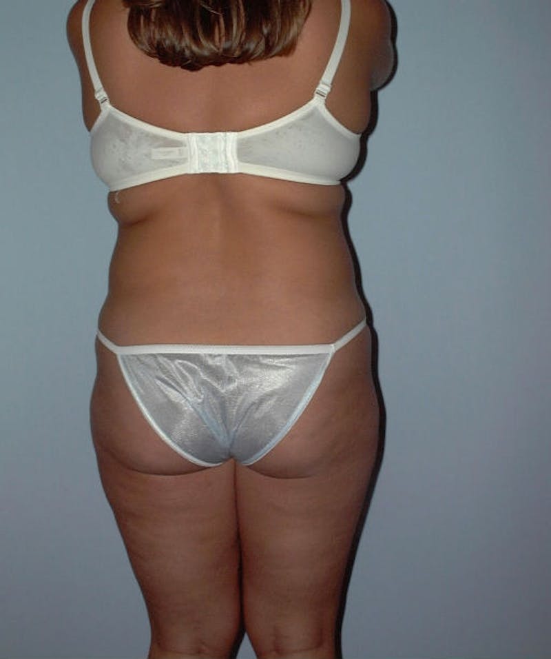 Liposuction Before & After Gallery - Patient 133023783 - Image 1
