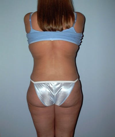 Liposuction Before & After Gallery - Patient 133023783 - Image 2