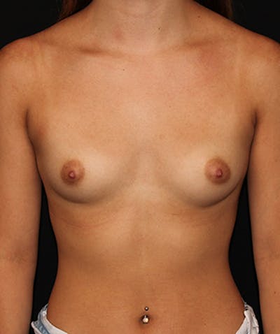 Breast Augmentation Before & After Gallery - Patient 133023794 - Image 1