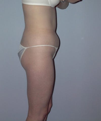 Liposuction Before & After Gallery - Patient 133023785 - Image 1