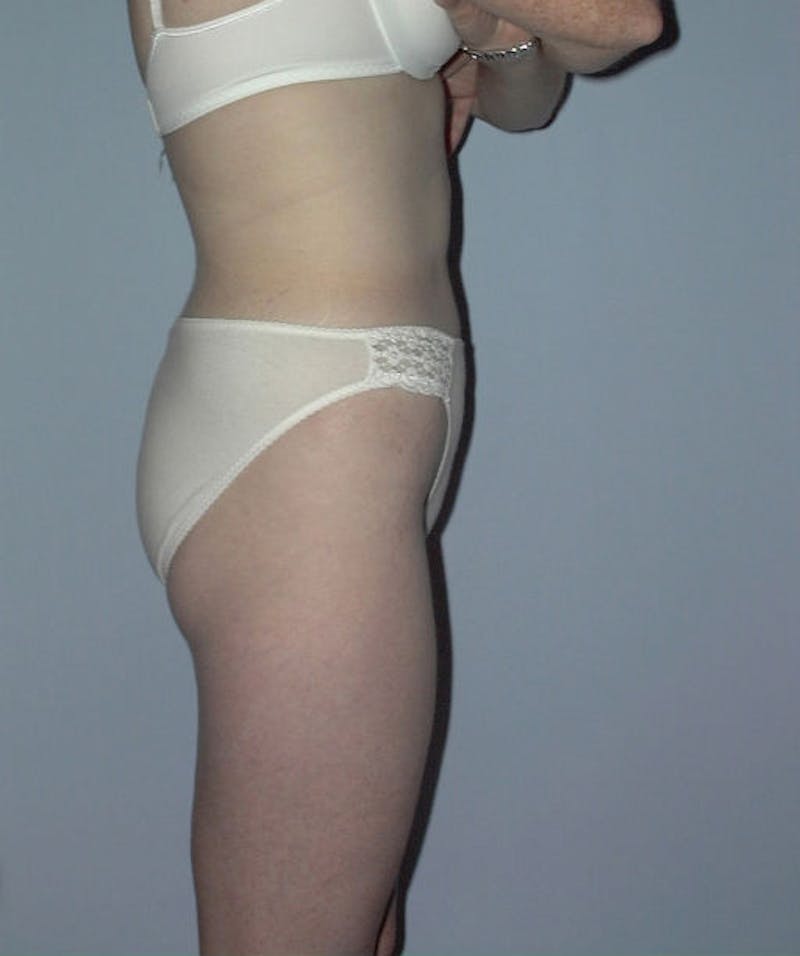 Liposuction Before & After Gallery - Patient 133023785 - Image 2