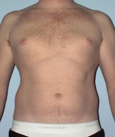 Liposuction Before & After Gallery - Patient 133023792 - Image 1