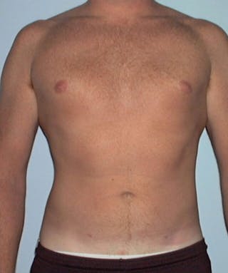 Liposuction Before & After Gallery - Patient 133023792 - Image 2
