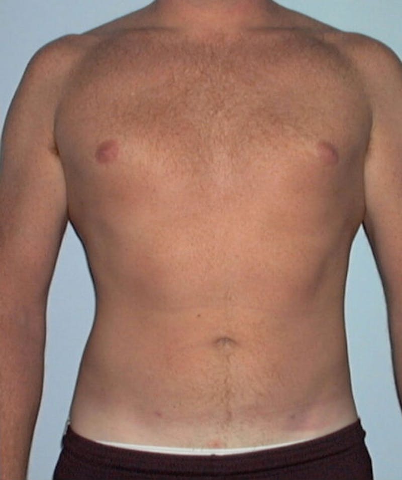 Liposuction Before & After Gallery - Patient 133023792 - Image 2