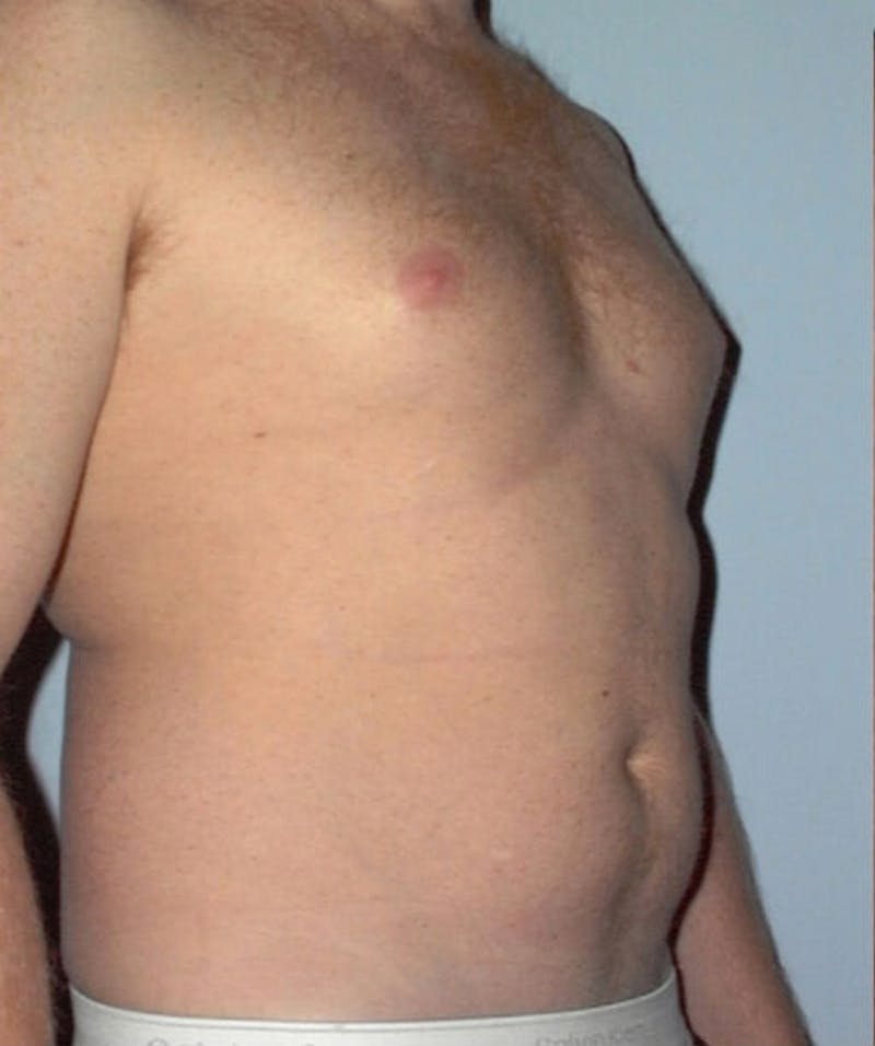 Liposuction Before & After Gallery - Patient 133023792 - Image 3