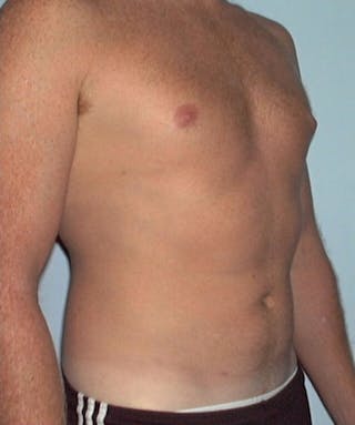 Liposuction Before & After Gallery - Patient 133023792 - Image 4